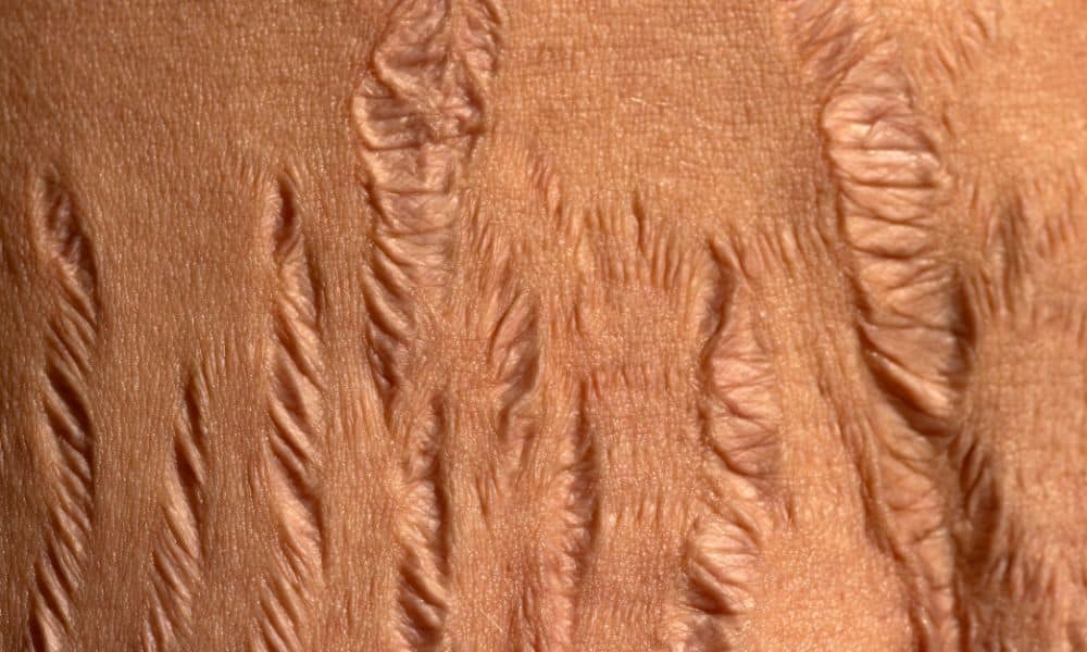 vergetures rouges femme